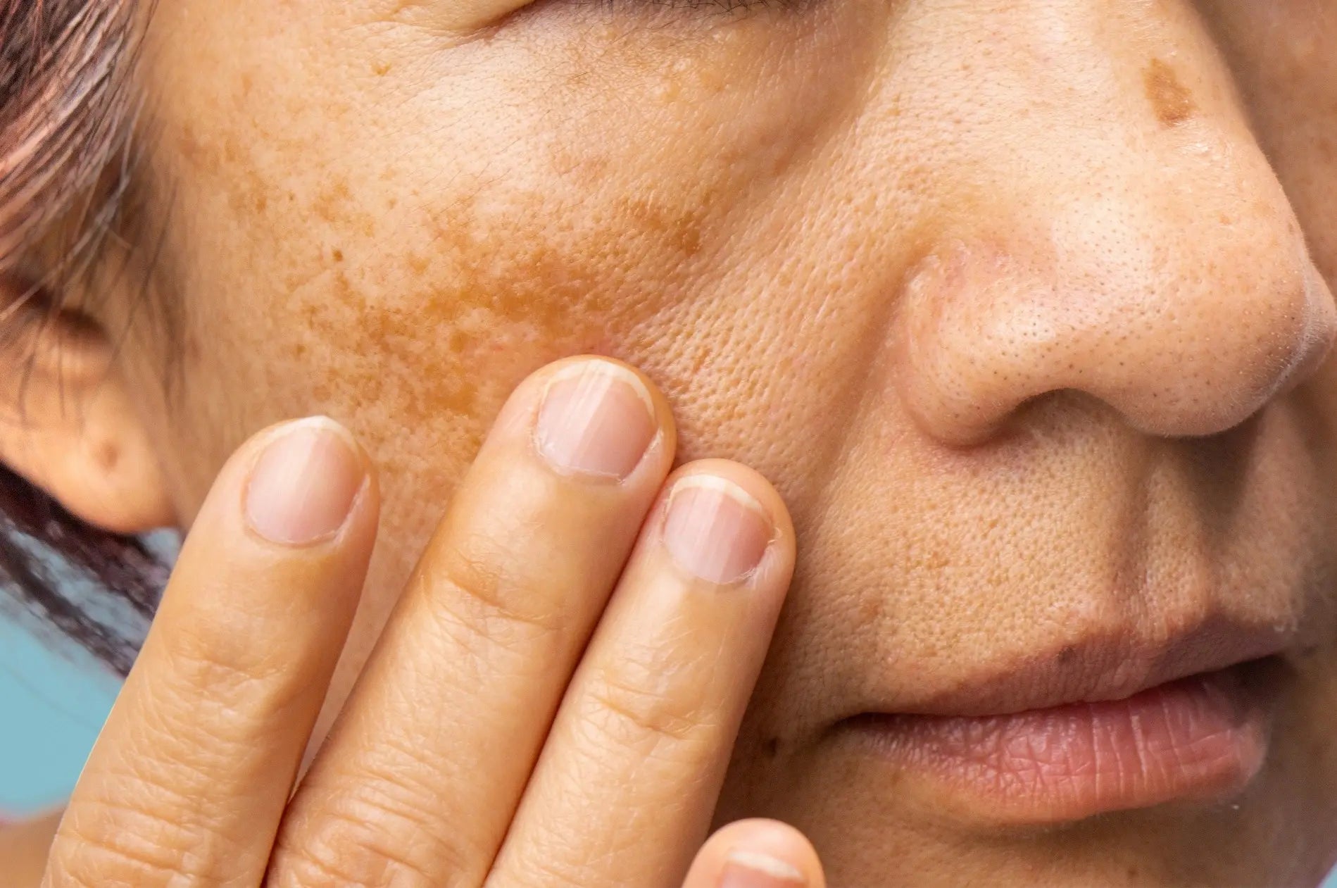 Symptoms and Causes of Melasma on Face