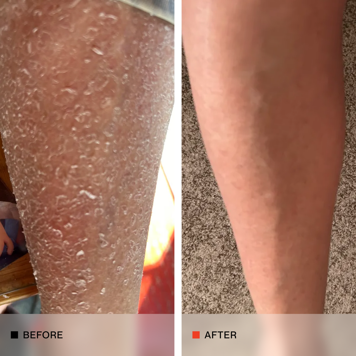 A side-by-side before and after comparison of a human leg, showing a dramatic reduction in dry, cracked, and bubbly skin on the left and smoother, healthier skin on the right.
