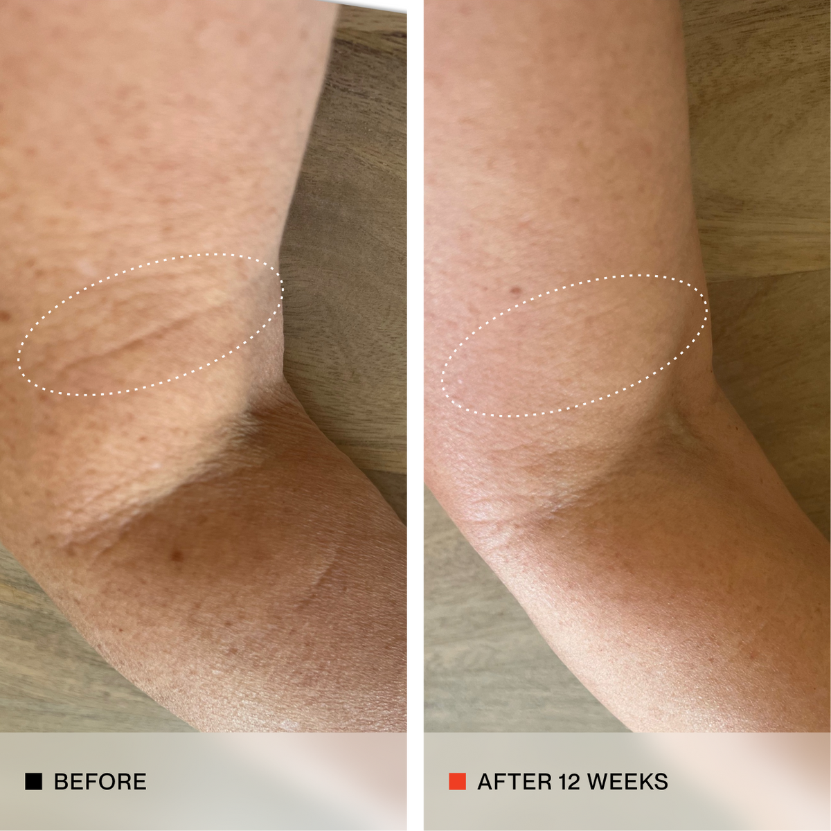 A side-by-side before and after comparison of an elbow showing skin texture and hyperpigmentation improvement over 12 weeks. The left panel is labeled 'BEFORE' with a black square icon, and the right panel is labeled 'AFTER 12 WEEKS' with a red square icon.