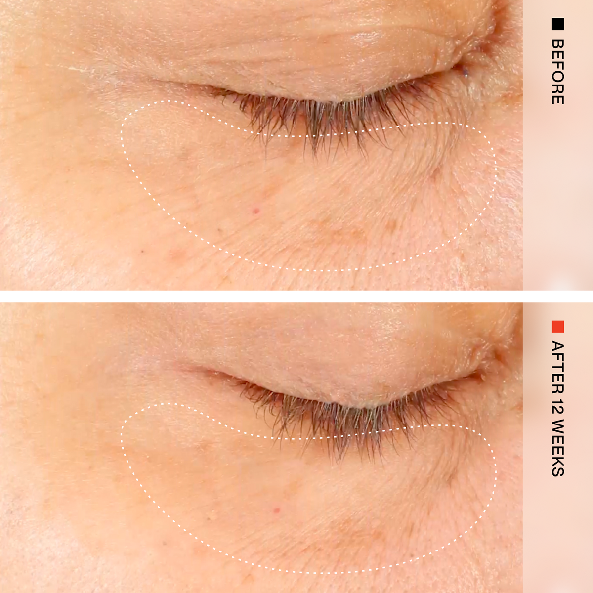 Before-and-after comparison of a closed eye showing skin texture and wrinkles around the eyelid, with dotted white outlines highlighting the treated area. The top panel is labeled BEFORE and the bottom panel is labeled AFTER 12 WEEKS.