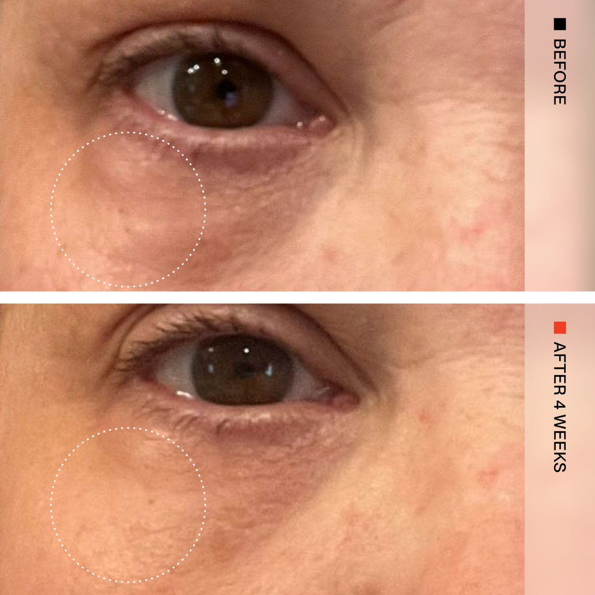 Before-and-after comparison of under-eye dark circles on a person's face, with the top labeled BEFORE and the bottom labeled AFTER 12 WEEKS. The image shows close-up views of the left eye area with a dotted circle highlighting the skin region.