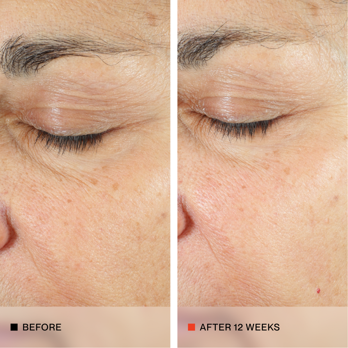 A side-by-side close-up comparison of an older person's eye and surrounding skin, labeled 'BEFORE' on the left and 'AFTER 12 WEEKS' on the right, showing visible skin improvement.