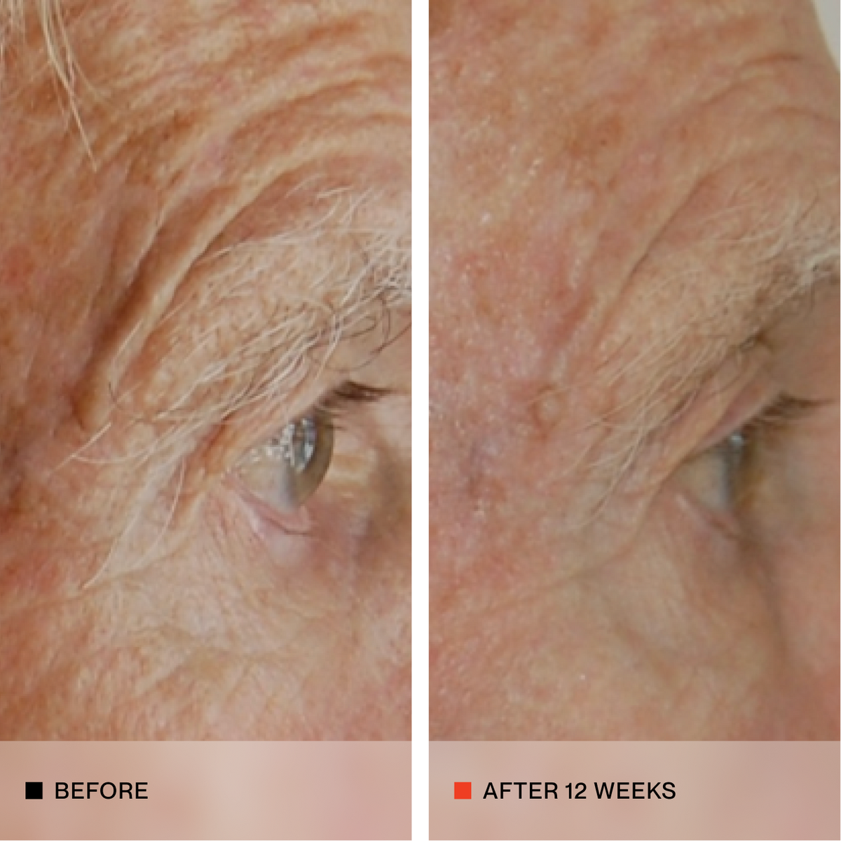 A side-by-side close-up comparison of an older person's eye and forehead, labeled 'BEFORE' on the left and 'AFTER 12 WEEKS' on the right, showing reduced wrinkles and sun damage over 12 weeks.