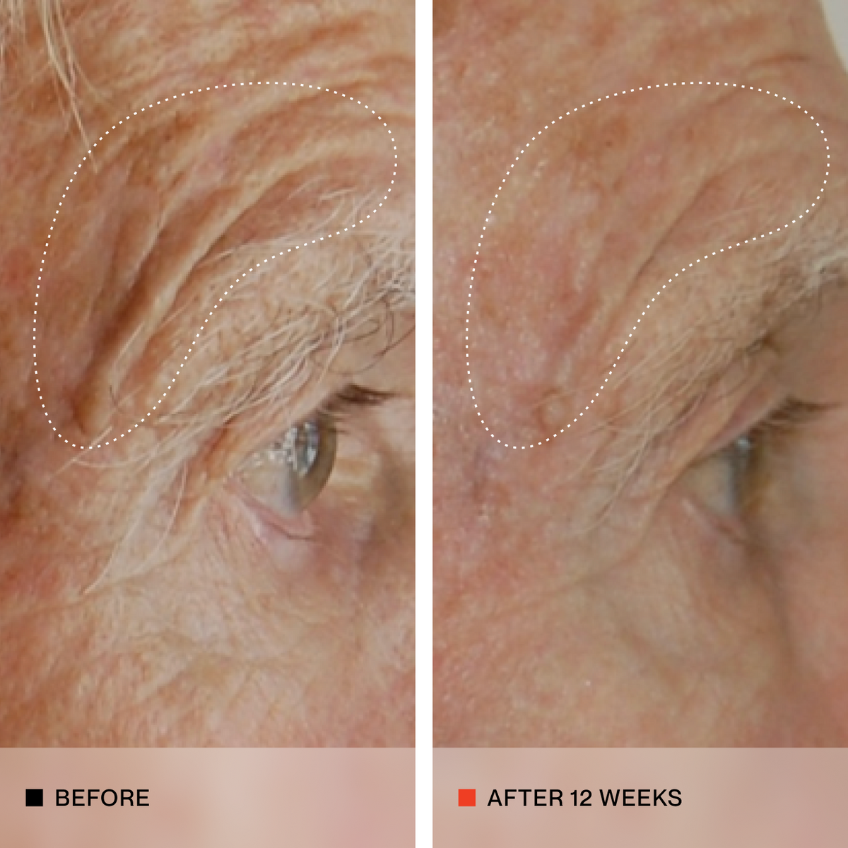 Side by side images of a person's skin with more elasticity, the left image is before and the right image is after 12 weeks