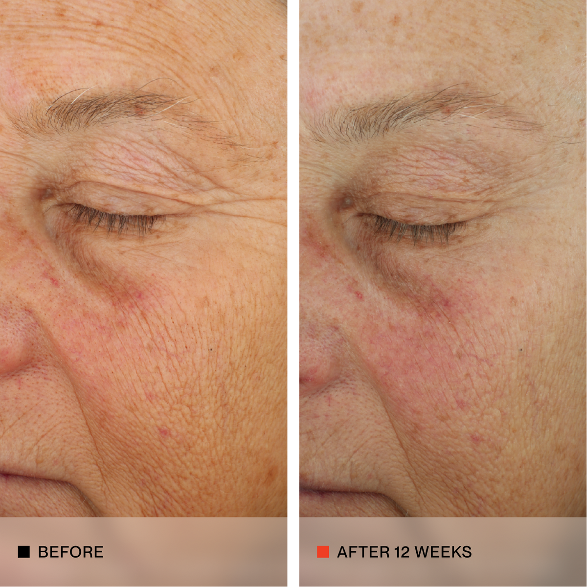 A side-by-side before and after comparison of an older woman's eye and cheek area, showing skin texture and wrinkles. The left panel is labeled 'BEFORE' and the right panel is labeled 'AFTER 12 WEEKS'.