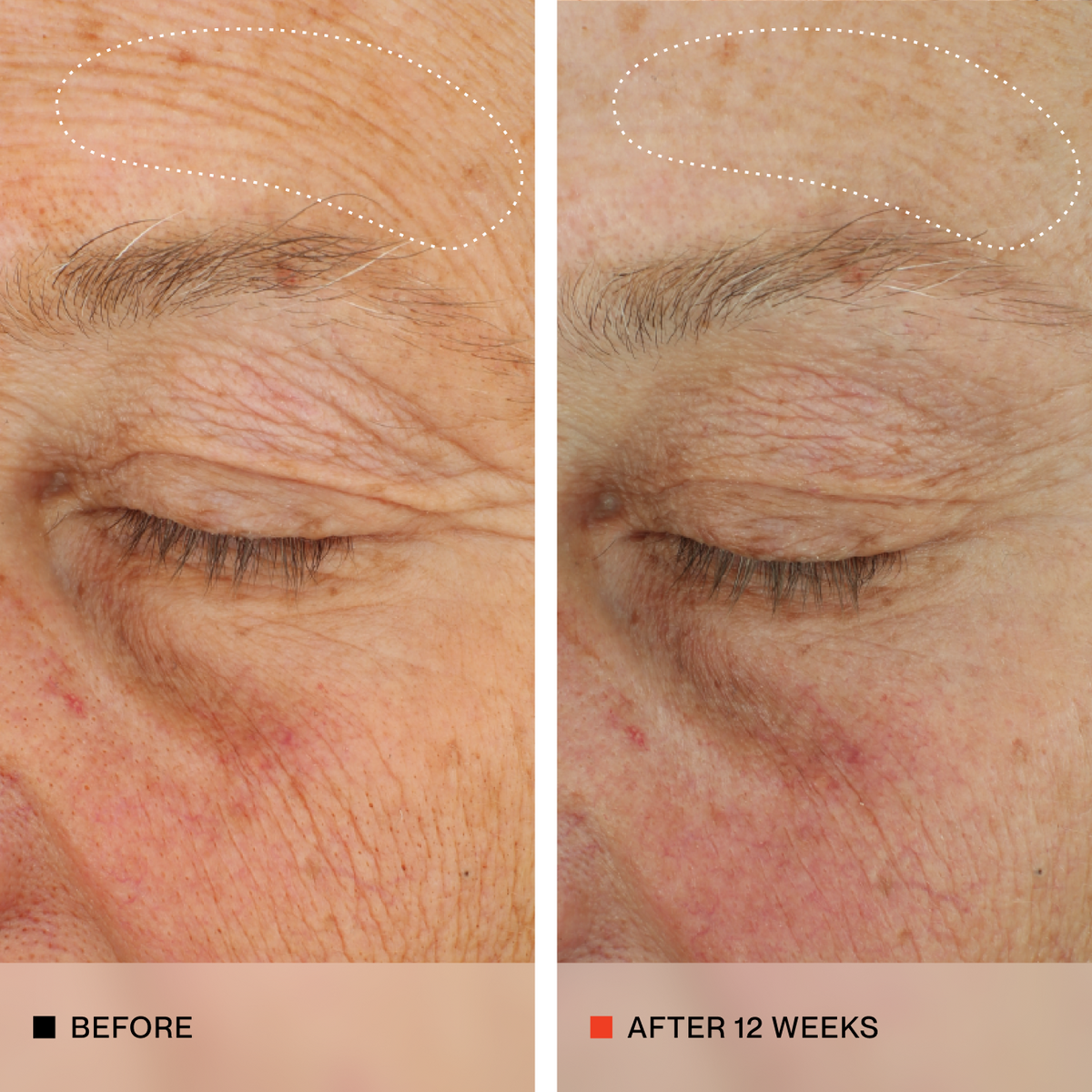 A side-by-side before and after comparison of an older person's forehead and eyebrow area, showing wrinkles and sun damage. The left panel is labeled BEFORE and shows more wrinkles around the eyebrow and forehead; the right panel is labeled AFTER 12 WEEKS and shows visibly smoother skin and reduced wrinkles.