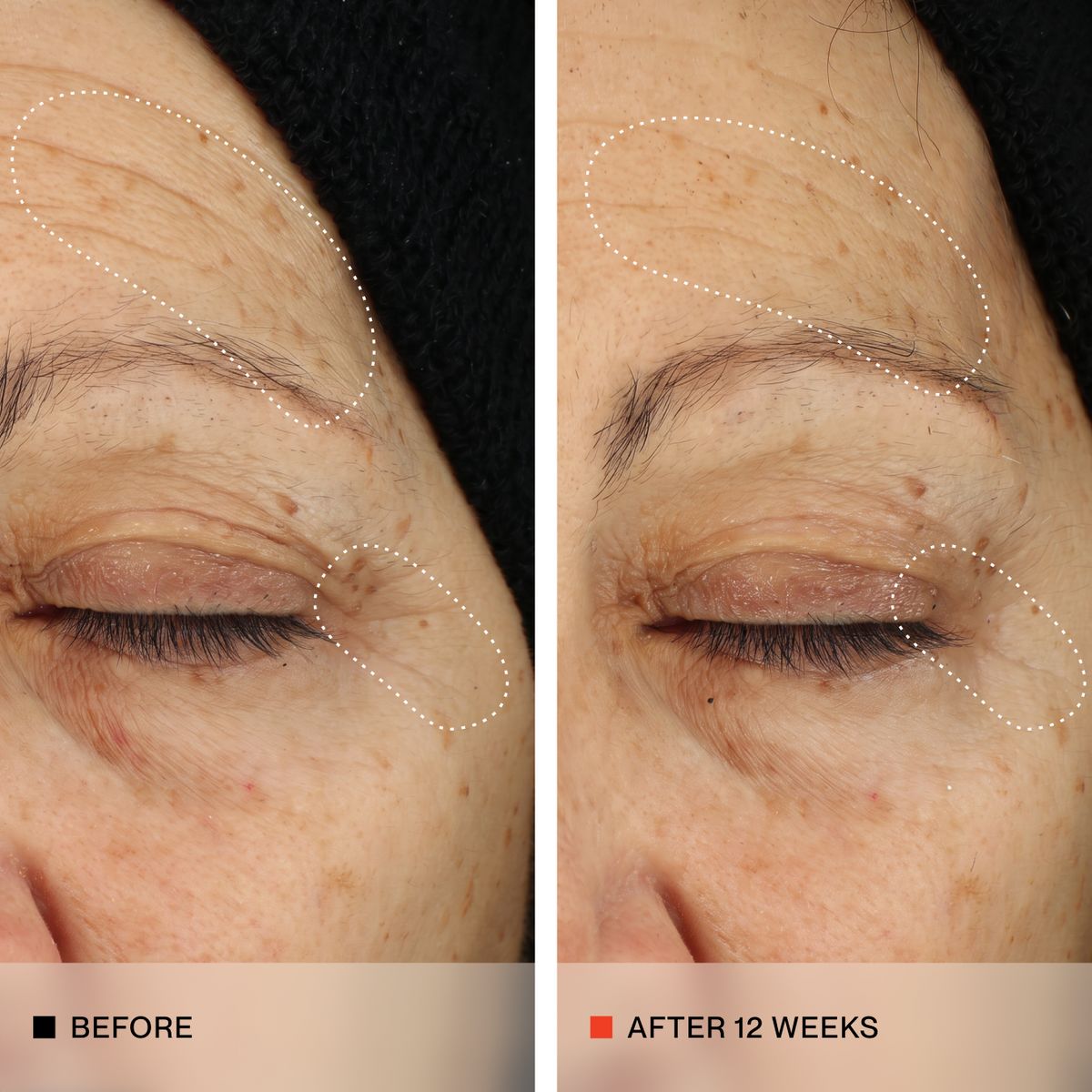 Side-by-side close-up of an older woman's eye area labeled 'BEFORE' and 'AFTER 12 WEEKS,' showing skin texture and wrinkle improvement with dotted white outlines highlighting treated areas.