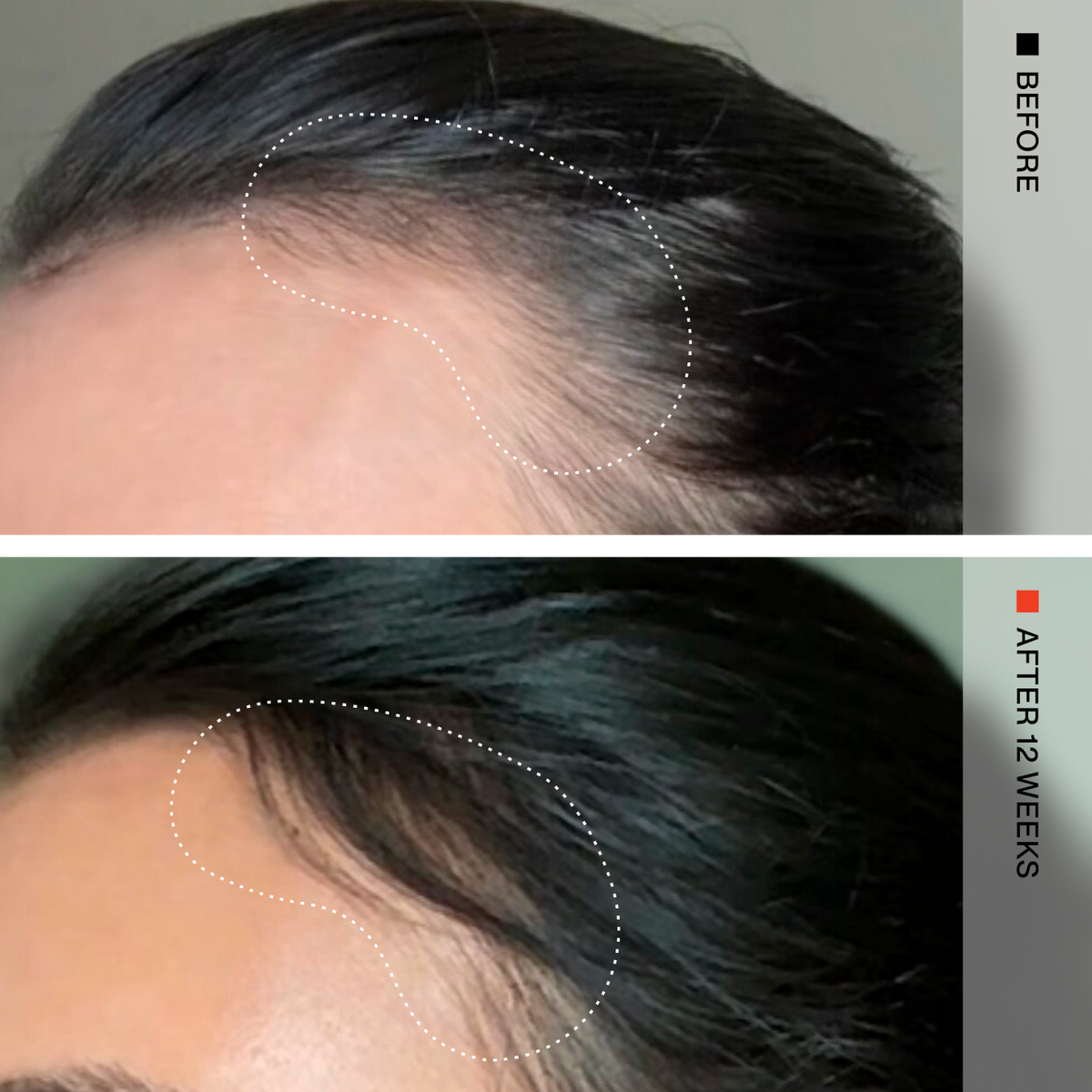 Before-and-after comparison of a person's hairline, showing hair growth progress over 12 weeks. The top panel is labeled 'BEFORE' and shows a thinning hairline outlined in a dotted white shape.