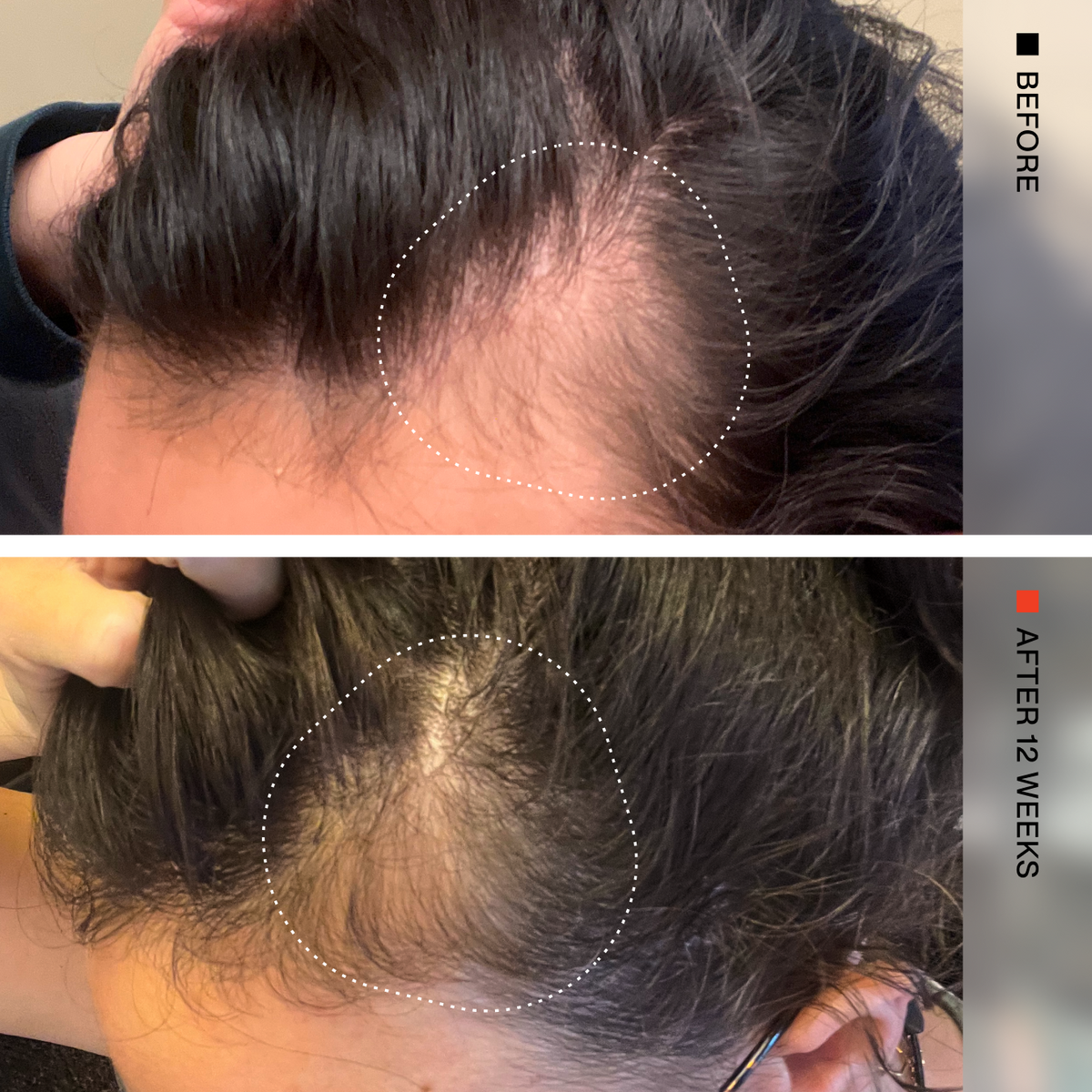 A before-and-after comparison of a person's scalp showing hair growth results. The top photo is labeled BEFORE and shows a visible hairline recession with dark hair and a white dotted circle highlighting the scalp.