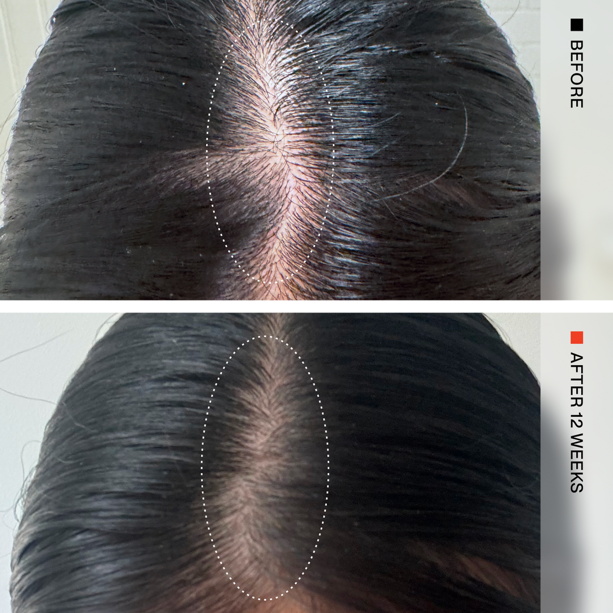 Before-and-after comparison of a person's scalp hairline, showing a wider part line and healthier-looking hair after 12 weeks. The top panel is labeled BEFORE and shows darker hair with a visible part line; the bottom panel is labeled AFTER 12 WEEKS and shows a finer, less visible part line.