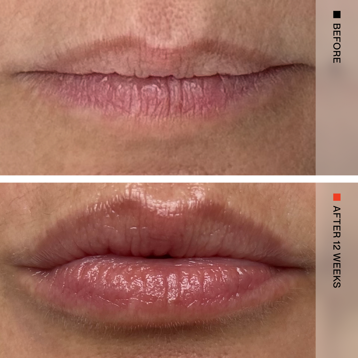 Close-up before-and-after comparison of a person's lips, with the top labeled BEFORE and the bottom labeled AFTER 12 WEEKS. The lower lip appears more hydrated and glossy in the after view.