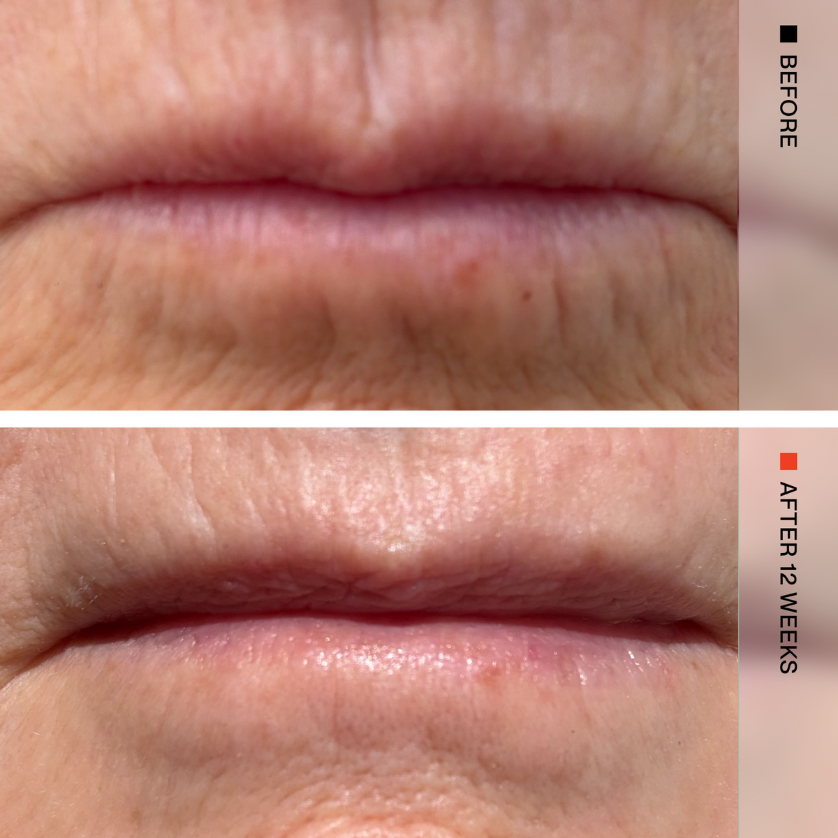 Close-up before-and-after comparison of lips, with the top panel labeled BEFORE and the bottom panel labeled AFTER 12 WEEKS. The image shows skin texture and lip condition over time.